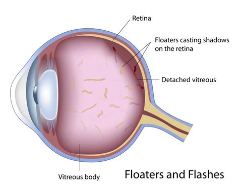 I think floaters are a reminder of our own mortality. . Neuroadaptation eye floaters